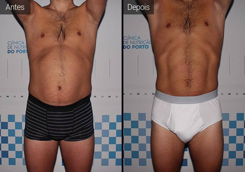 Correcção da gordura localizada no abdómen Gordura abdominal