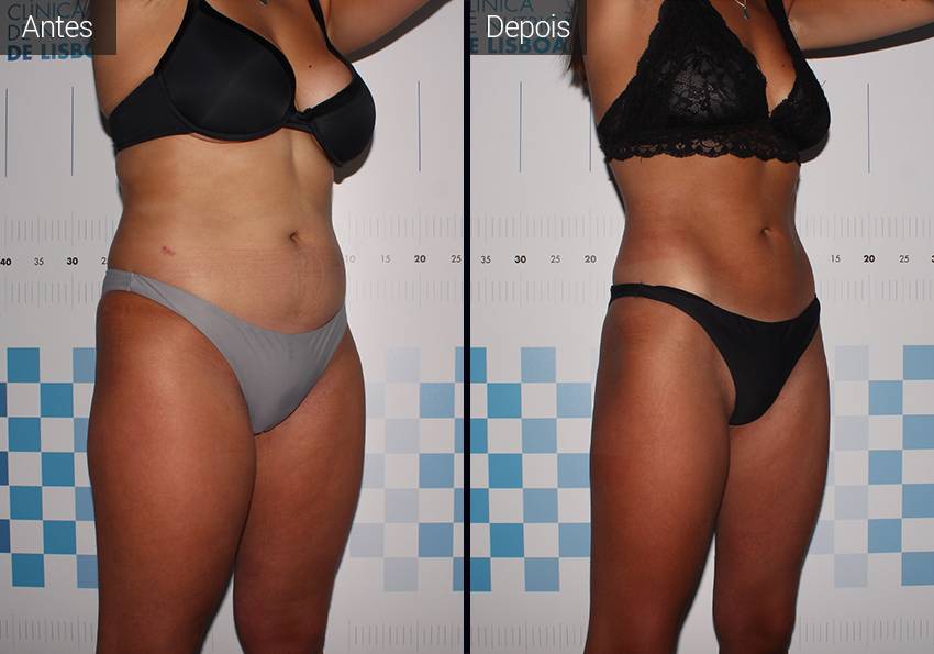 Remodelação Corporal - Mulher Jovem Resultados - Antes e Depois - Mulher Jovem