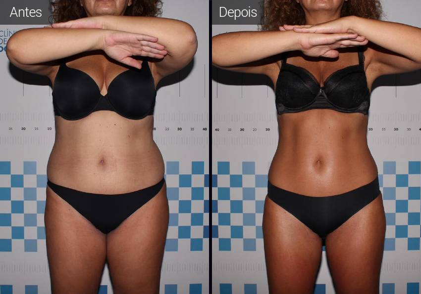 Remodelação corporal - Mulher Menopausa Resultados - Antes e Depois - Mulher Menopausa