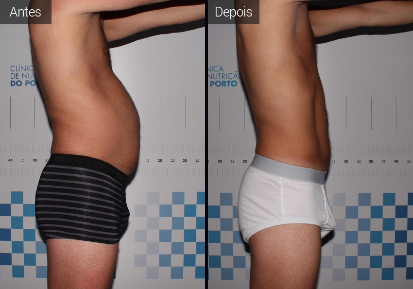 resultados - abdomen - flancos