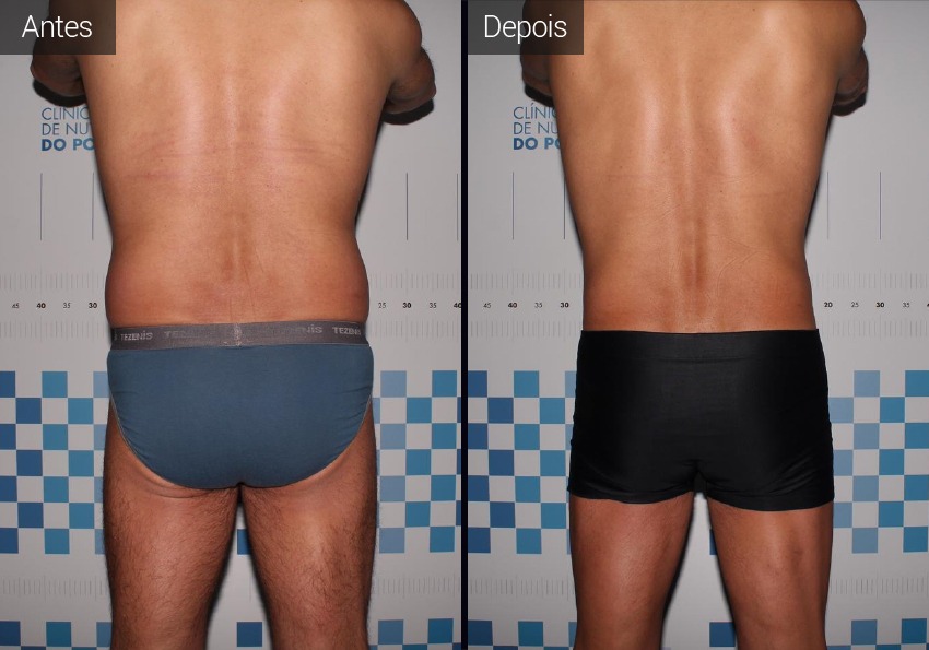 resultados - flancos - vista posterior