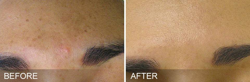 hydrafacial, nutricionista, resultados, manchas