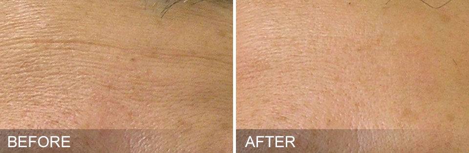 hydrafacial, nutricionista, resultados, pele-lisa