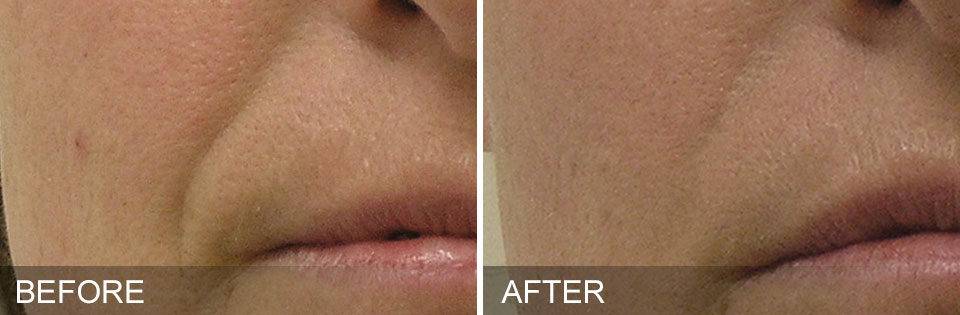 hydrafacial, nutricionista, resultados, rugas