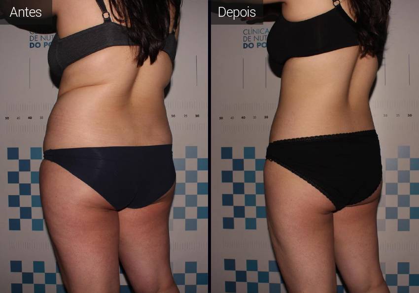LPG | endermologia - Resultados LPG - Resultados Antes e Depois
