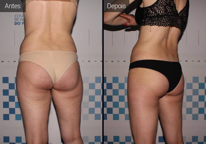 Resultados Radiofrequência Endymed - Resultados Antes e Depois